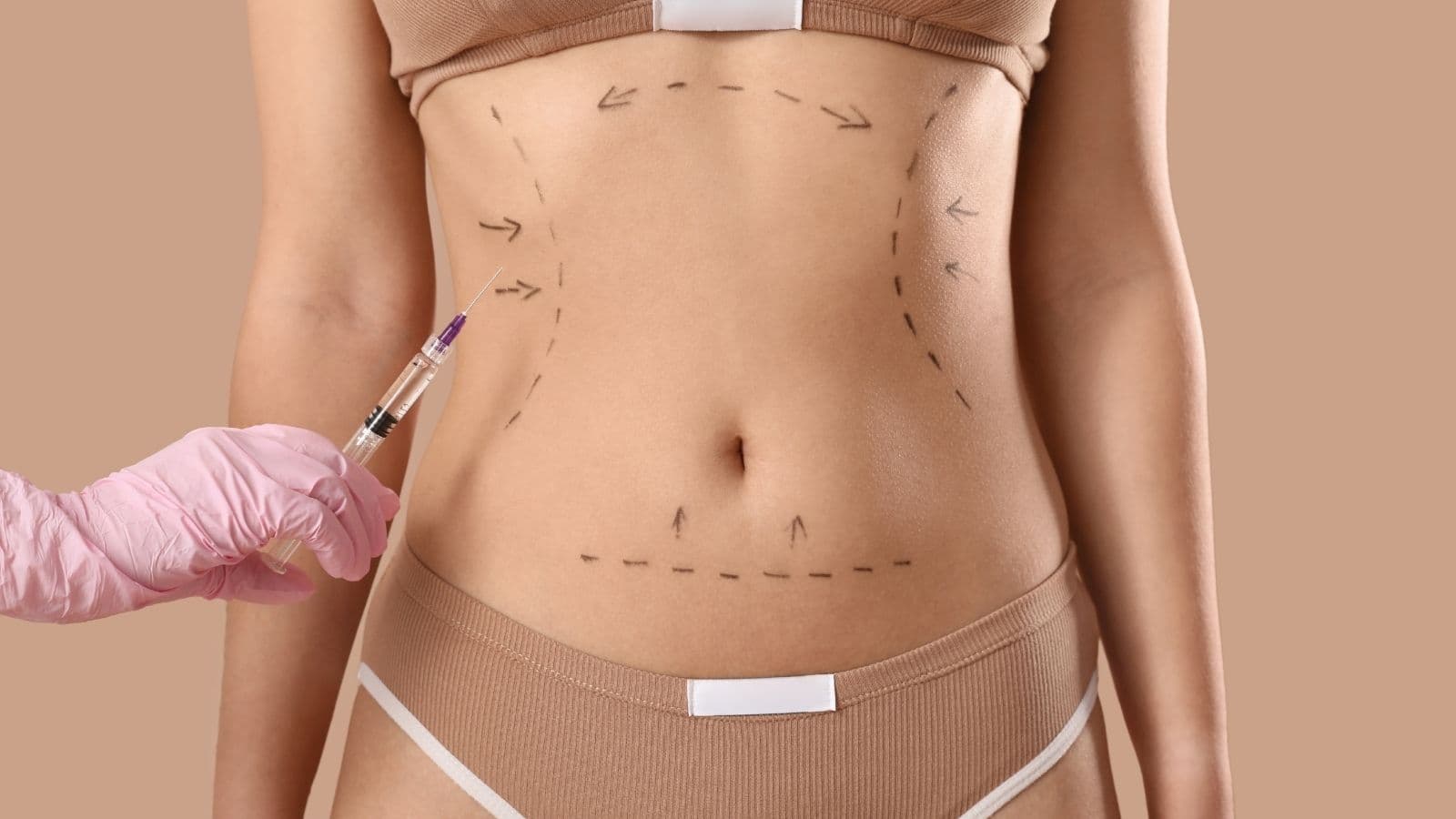 Liposuktion — Illustration eines bariatrischen Eingriffs
