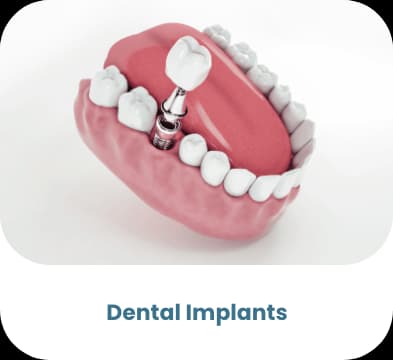 Implante Dental — procedimiento bariátrico