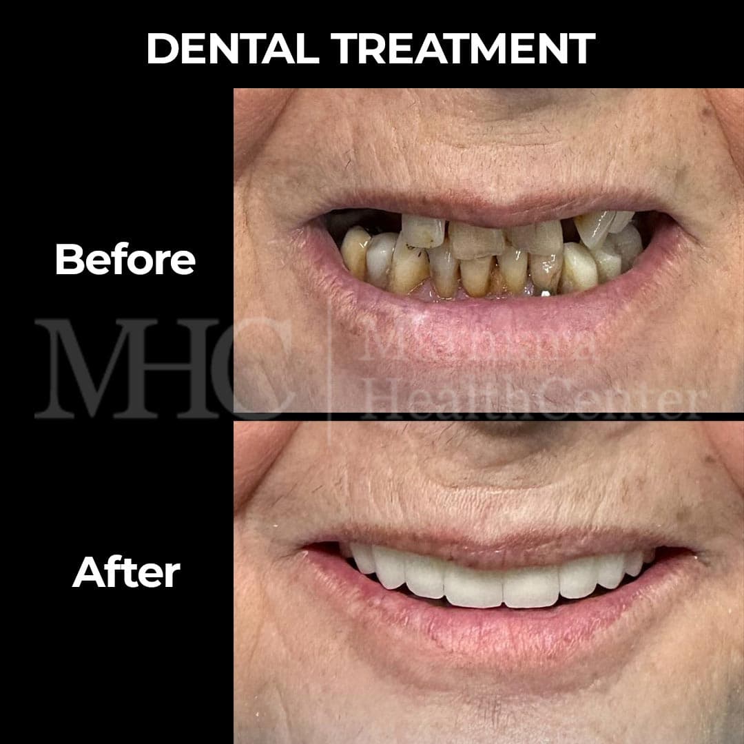Dental treatment before-after result #4 — Marmara Health Center
