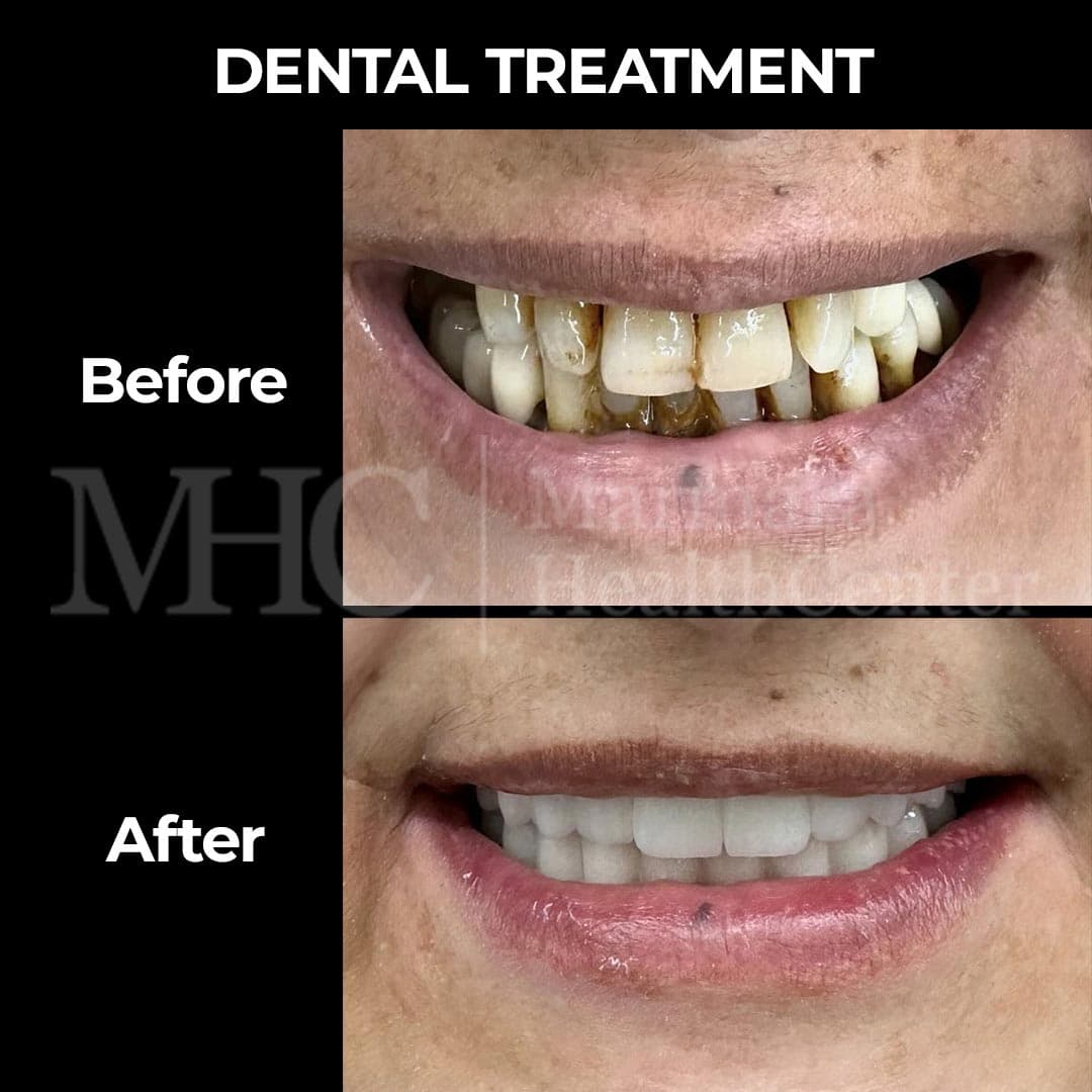 Dental treatment before-after result #5 — Marmara Health Center