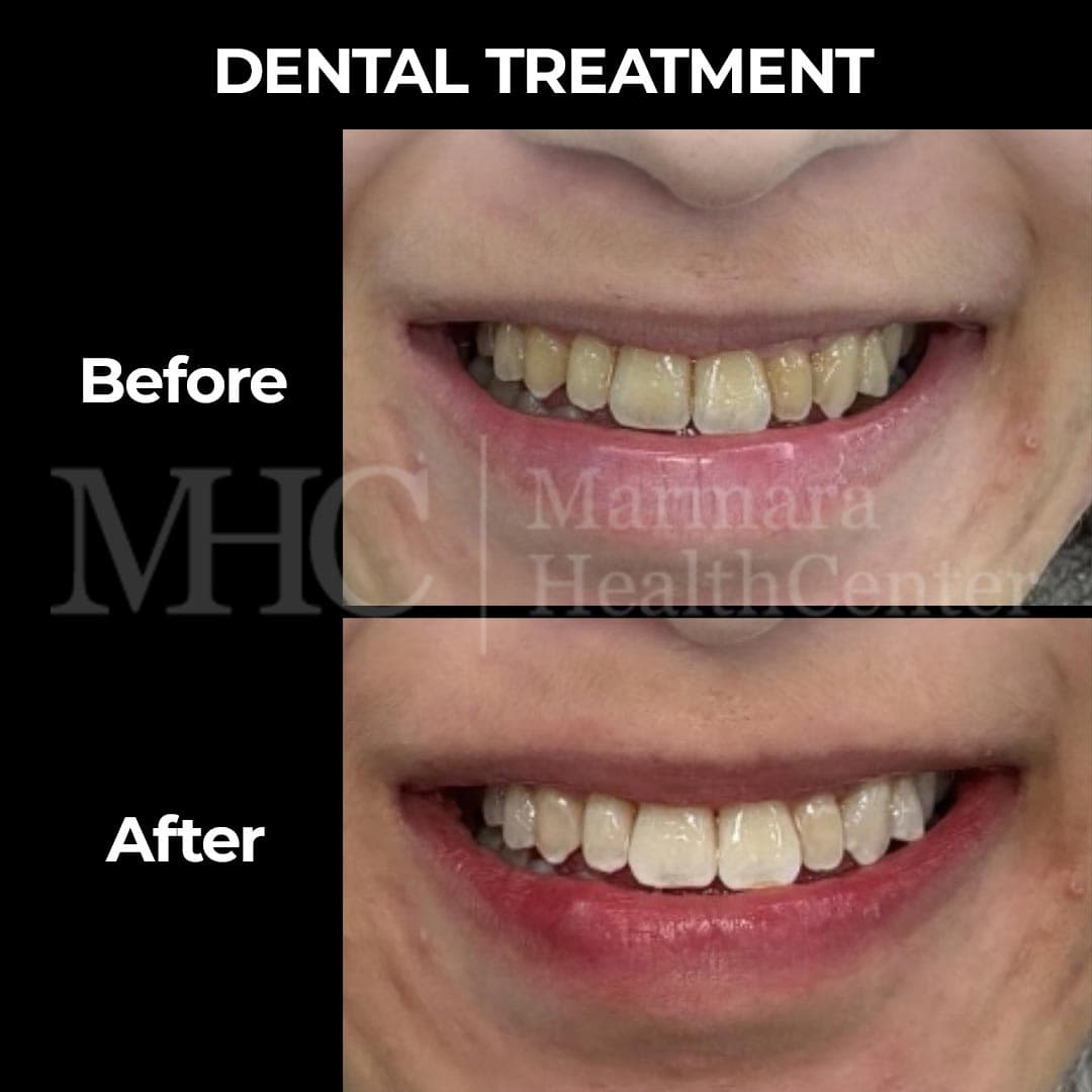 Dental treatment before-after result #6 — Marmara Health Center