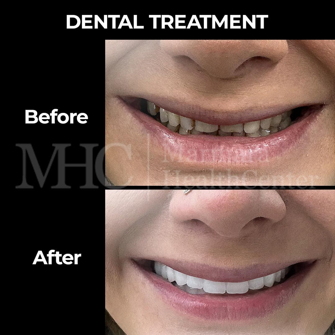 Dental treatment before-after result — full mouth restoration