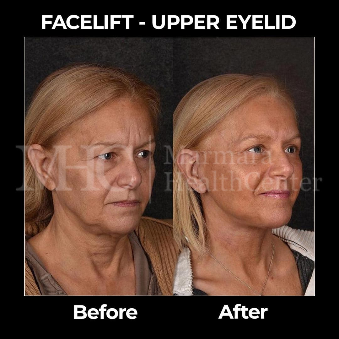 Facelift with upper eyelid before-after — anti-aging surgery