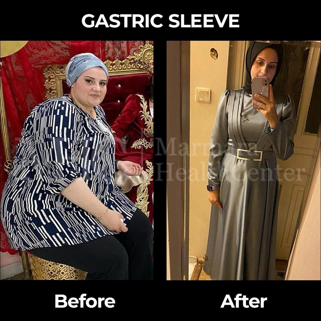 Gastric sleeve before-after result #10 — bariatric surgery outcome