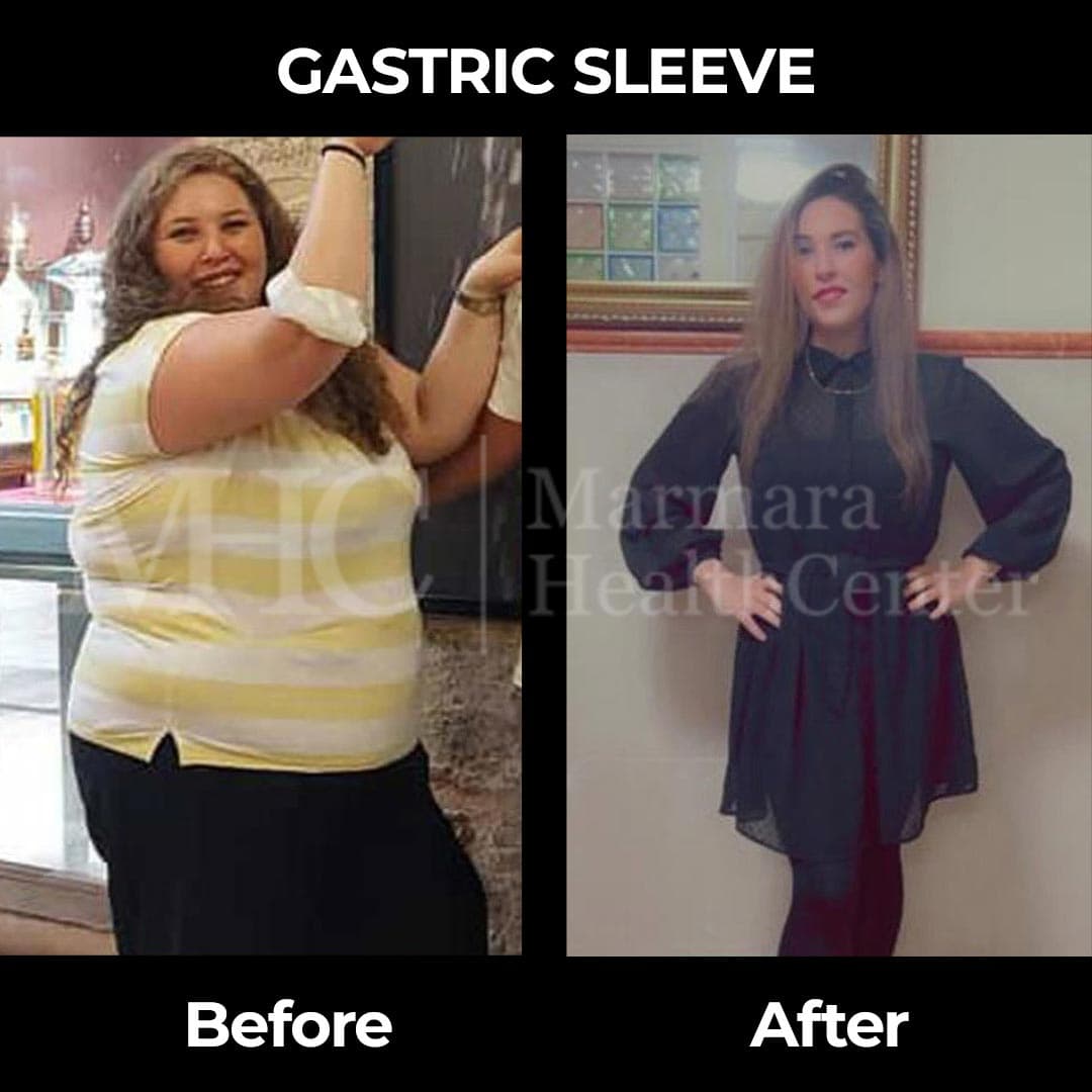 Gastric sleeve before-after result #11 — bariatric surgery outcome
