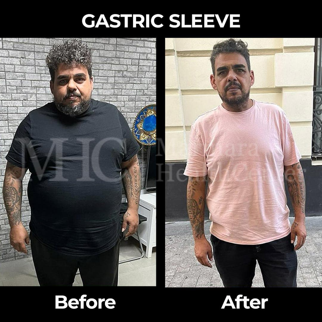 Gastric sleeve before-after result #12 — bariatric surgery outcome