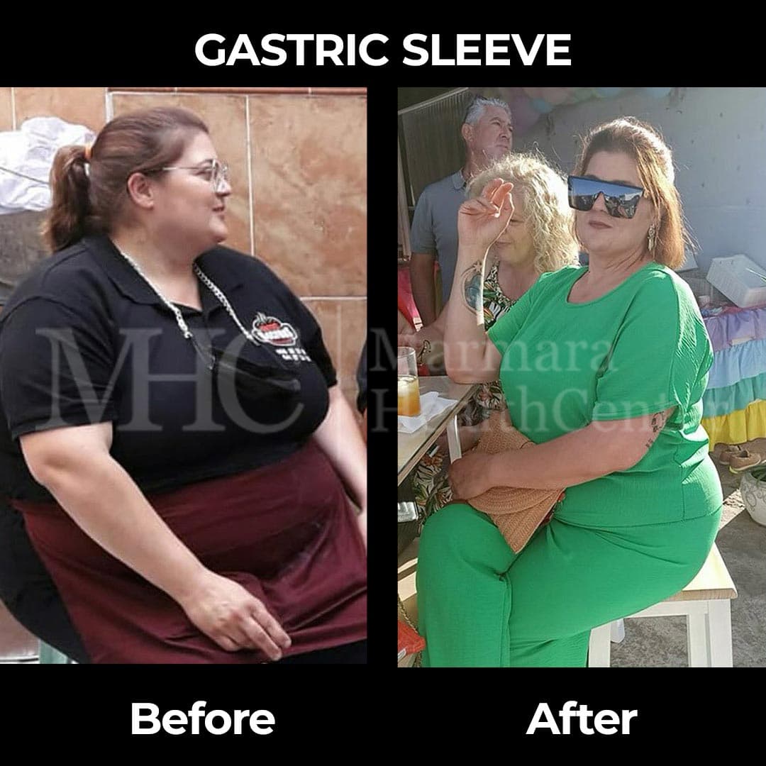 Gastric sleeve before-after result #13 — bariatric surgery outcome