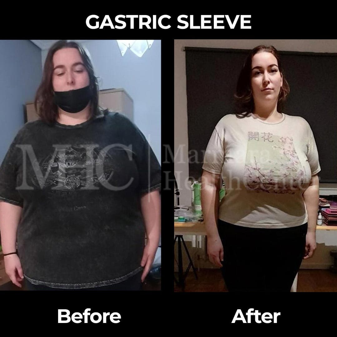 Gastric sleeve before-after result #14 — bariatric surgery outcome