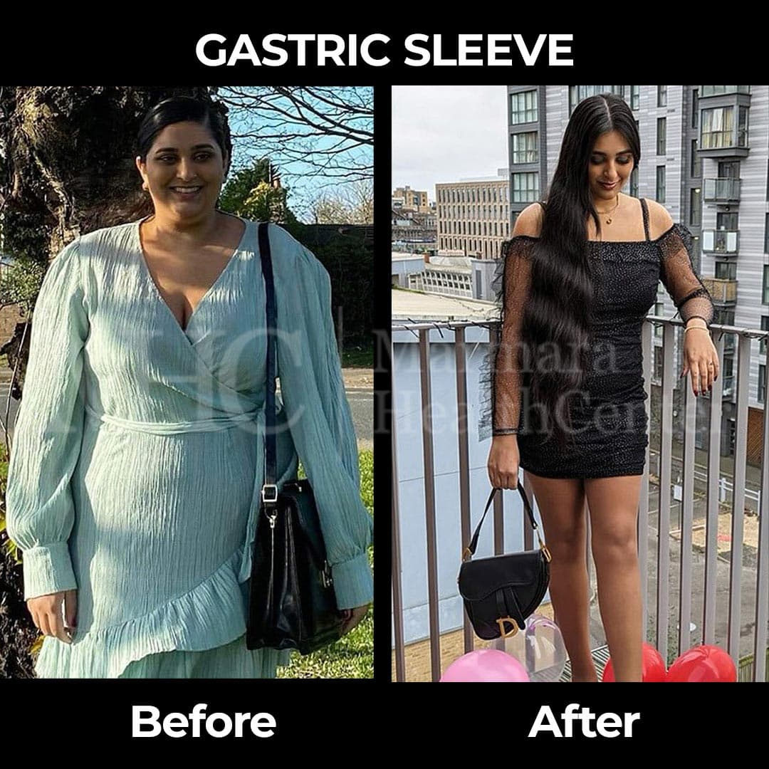Gastric sleeve before-after result #15 — bariatric surgery outcome
