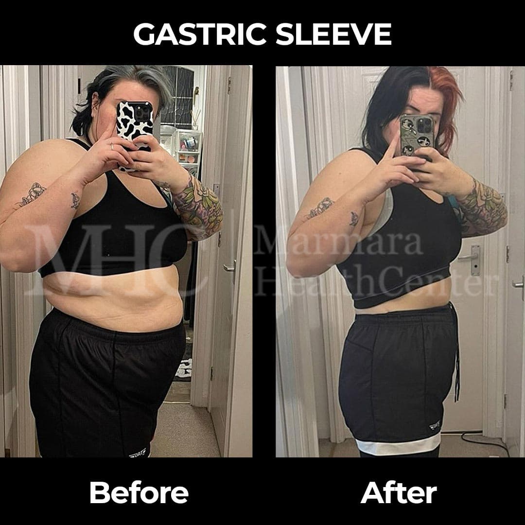 Gastric sleeve before-after result #16 — bariatric surgery outcome