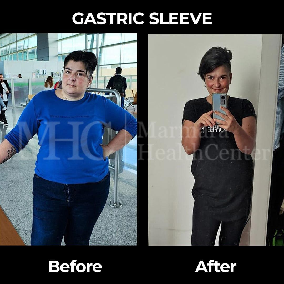 Gastric sleeve before-after result #17 — bariatric surgery outcome
