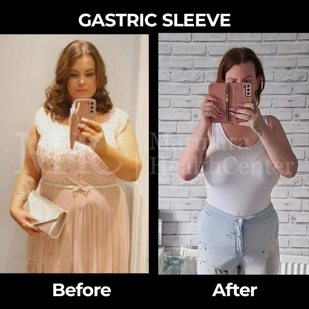 Gastric sleeve before-after result #18 — bariatric surgery outcome