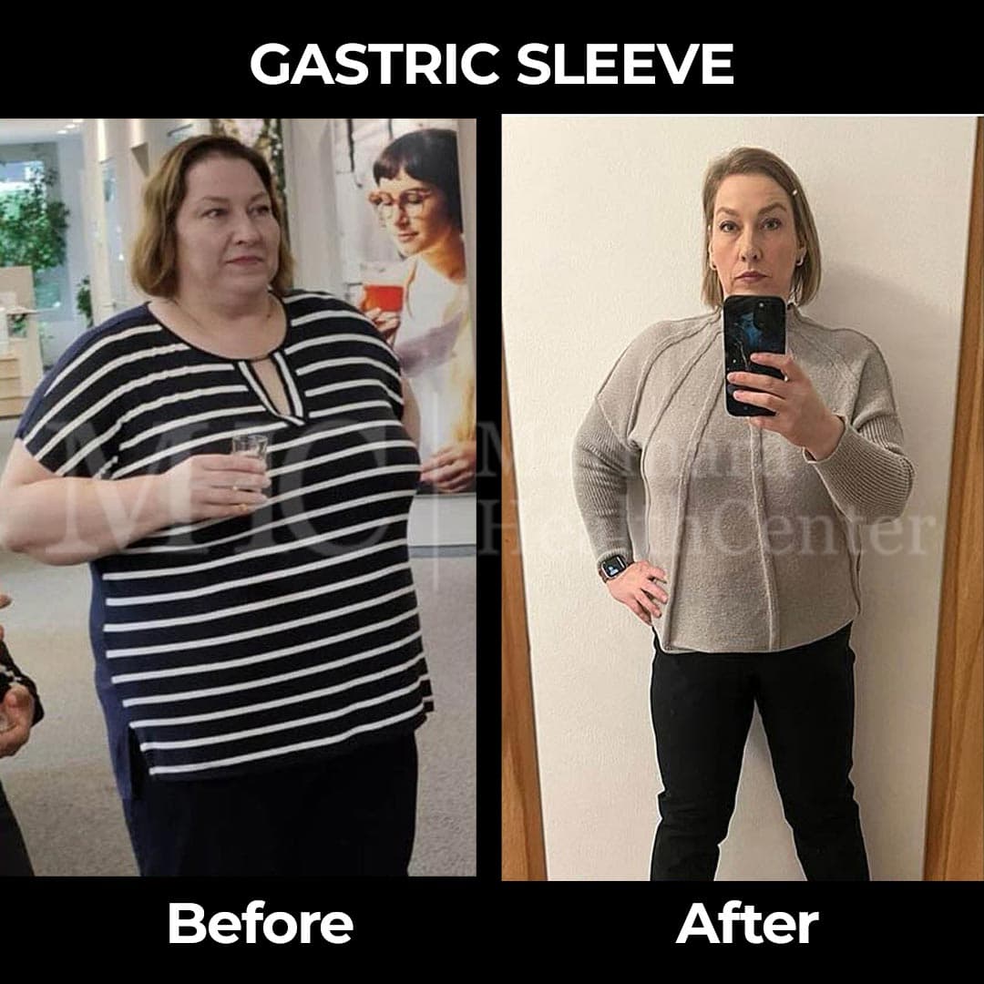 Gastric sleeve before-after result #19 — bariatric surgery outcome