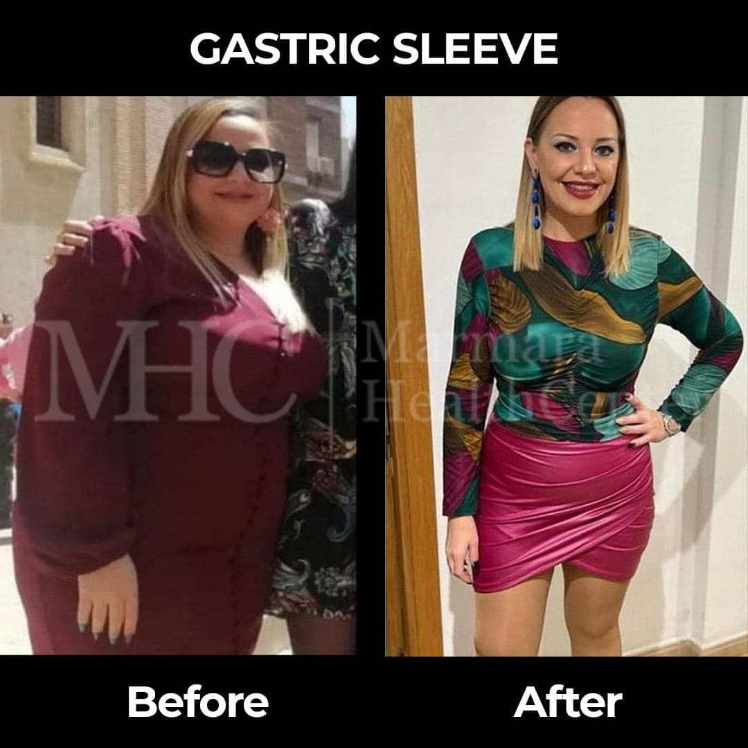 Gastric sleeve before-after result — bariatric surgery