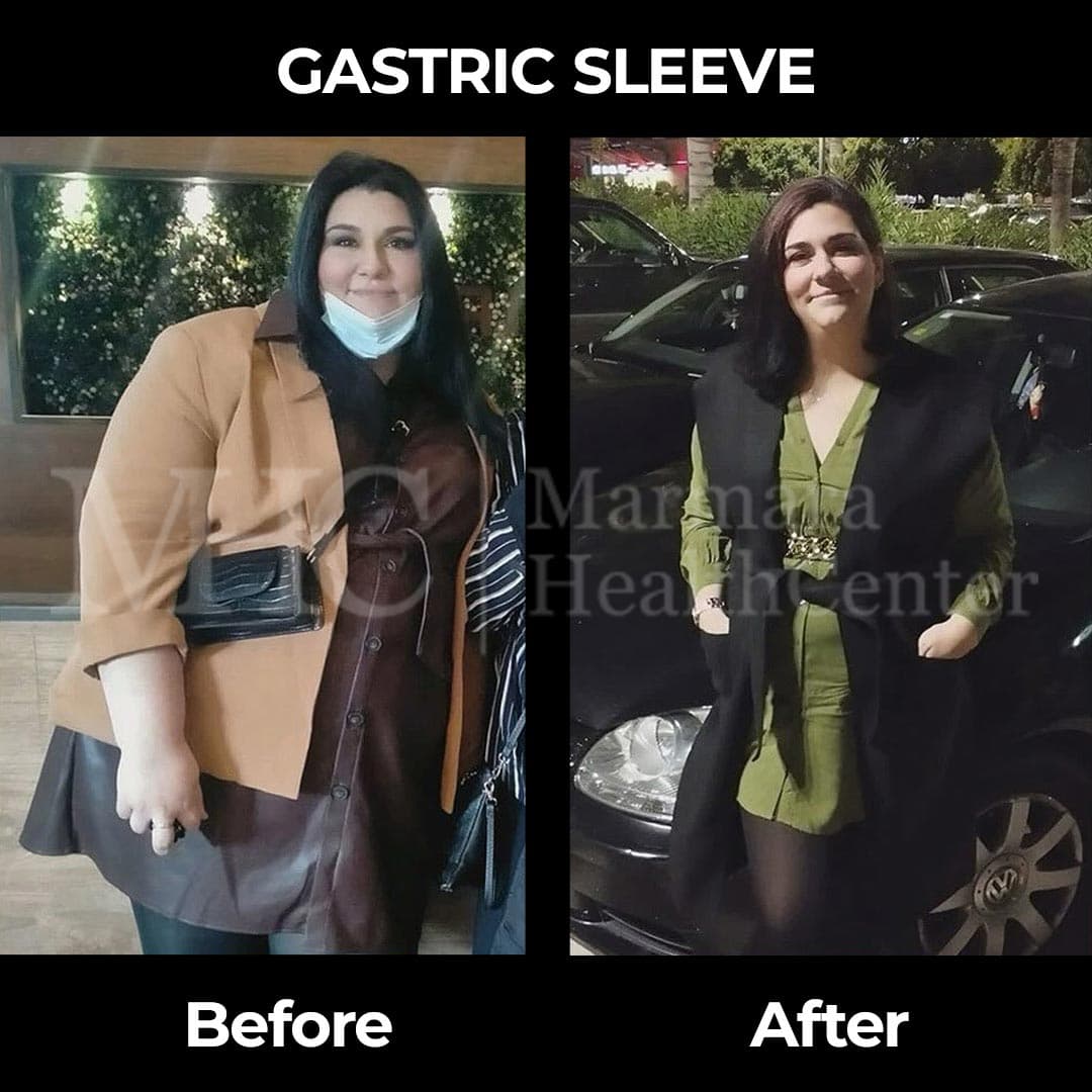 Gastric sleeve before-after result #20 — bariatric surgery outcome
