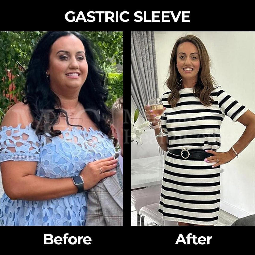 Gastric sleeve before-after result #21 — bariatric surgery outcome