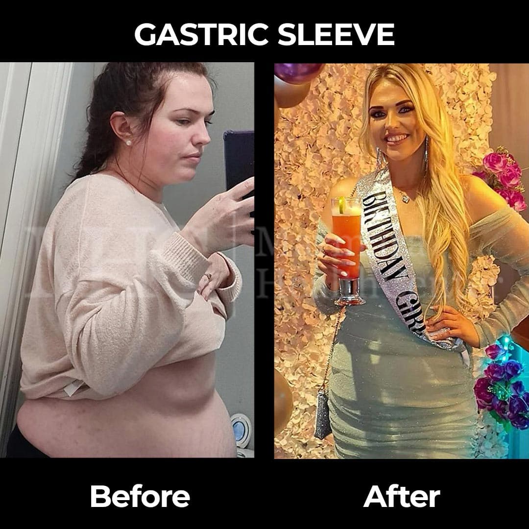 Gastric sleeve before-after result #22 — bariatric surgery outcome