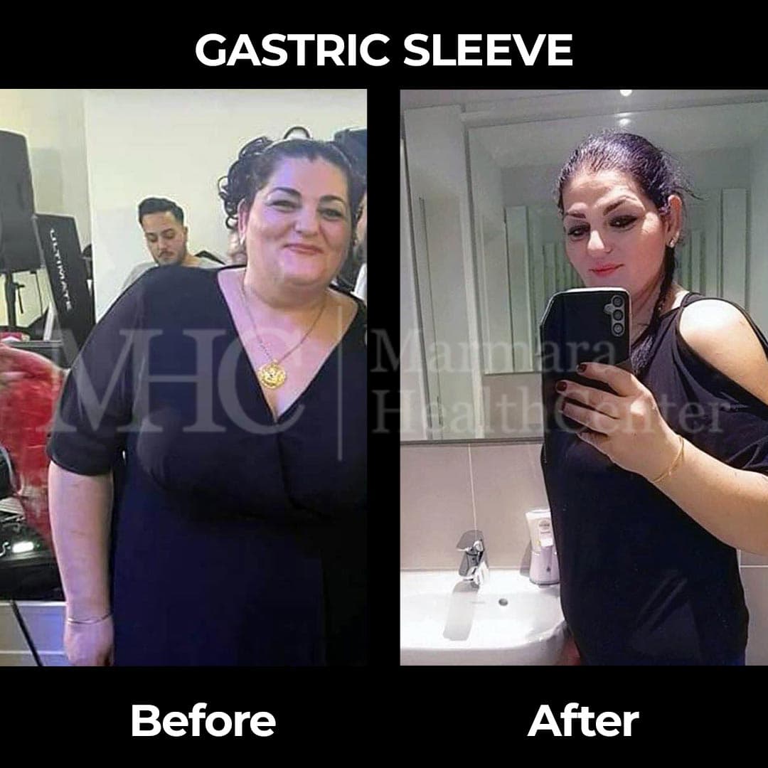 Gastric sleeve before-after result #23 — bariatric surgery outcome