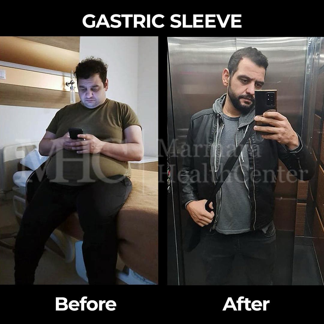 Gastric sleeve before-after result #24 — bariatric surgery outcome