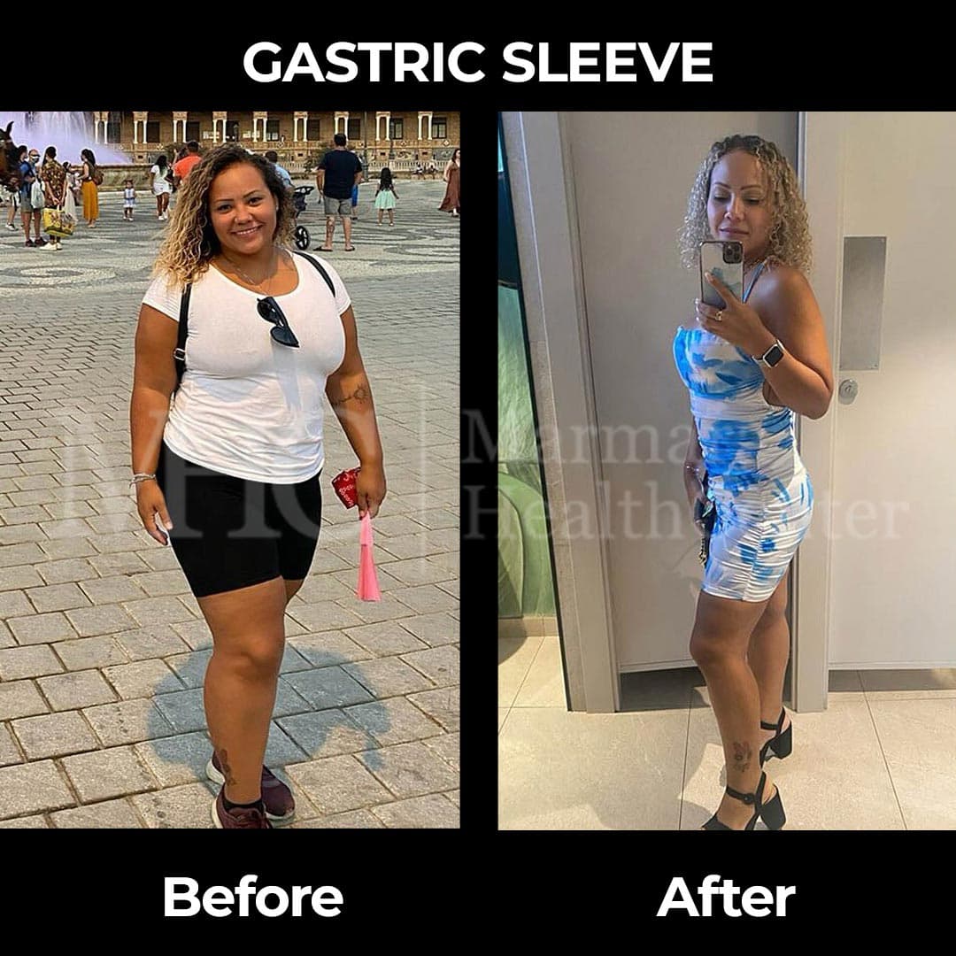 Gastric sleeve before-after result #25 — bariatric surgery outcome
