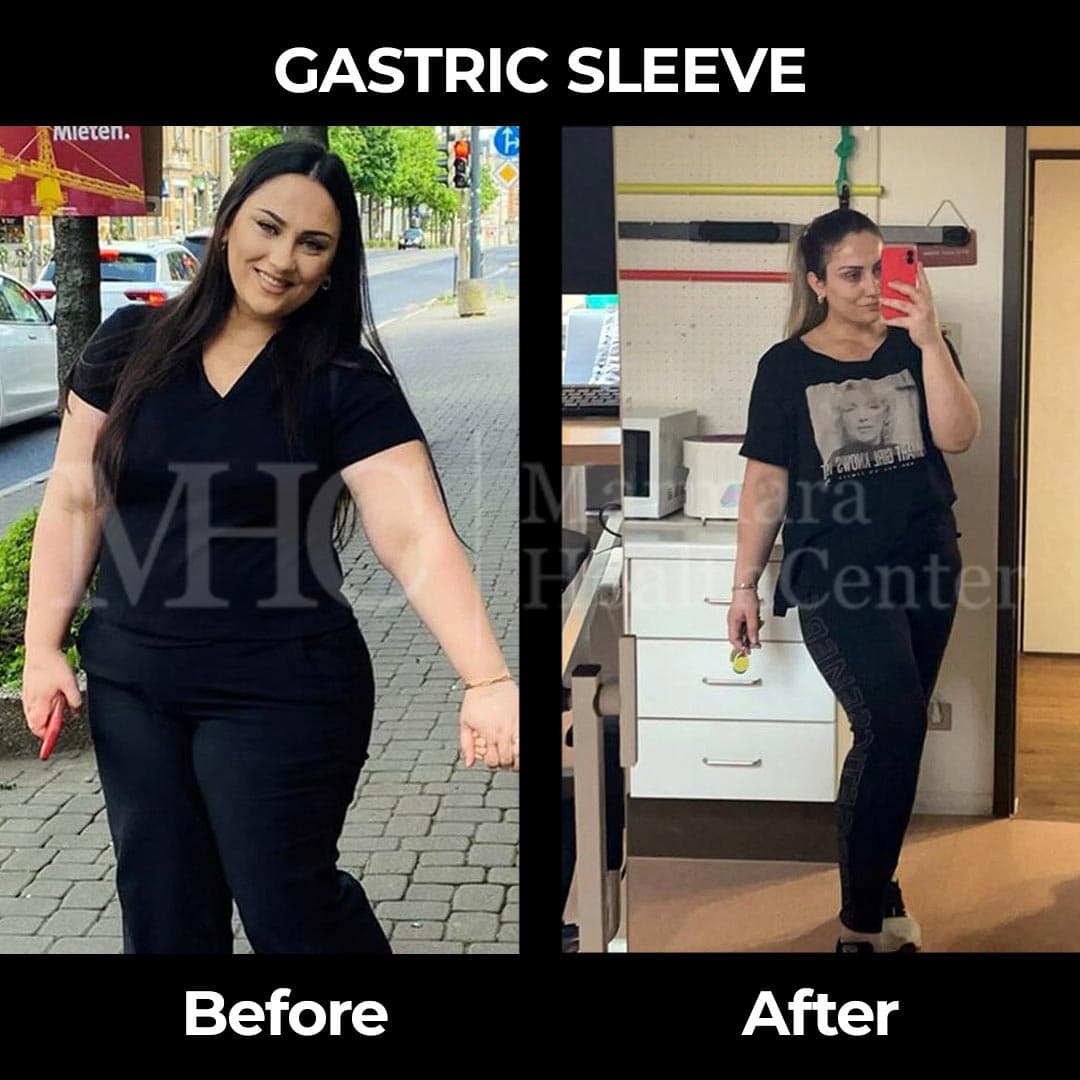 Gastric sleeve before-after result #26 — bariatric surgery outcome