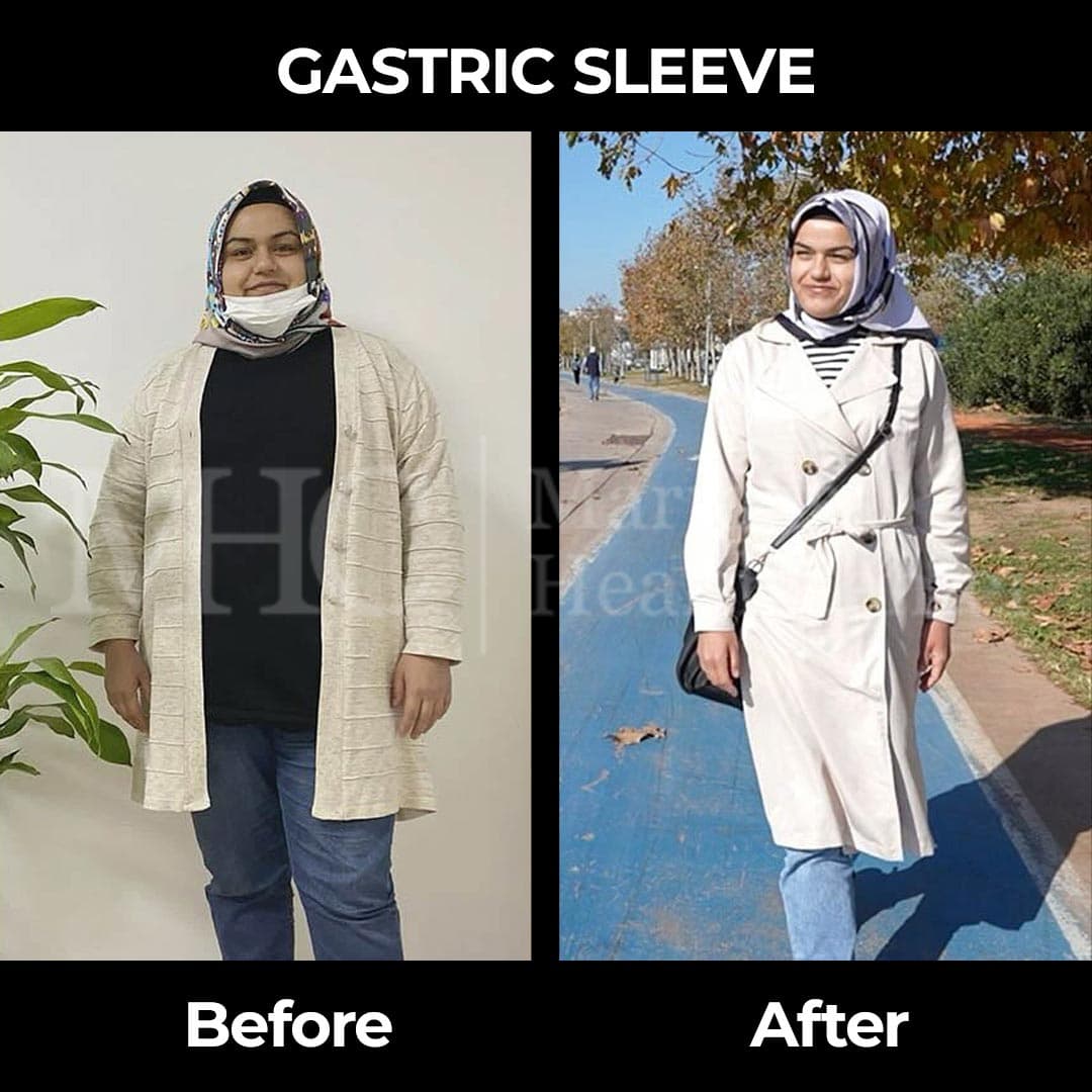 Gastric sleeve before-after result #27 — bariatric surgery outcome