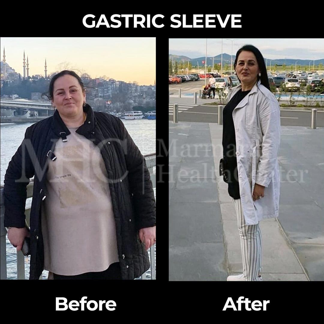 Gastric sleeve before-after result #28 — bariatric surgery outcome