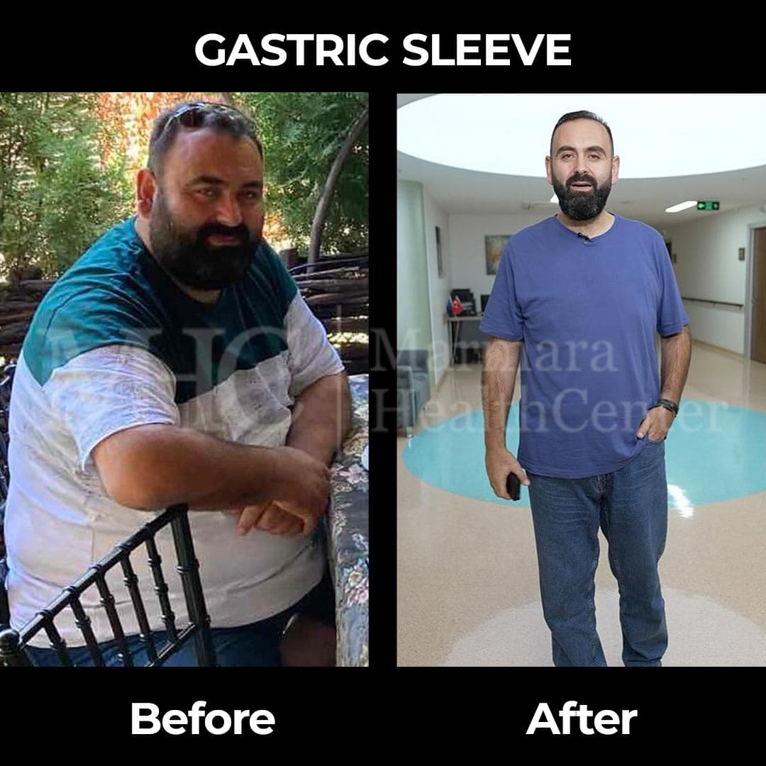 Gastric sleeve before-after result #29 — bariatric surgery outcome