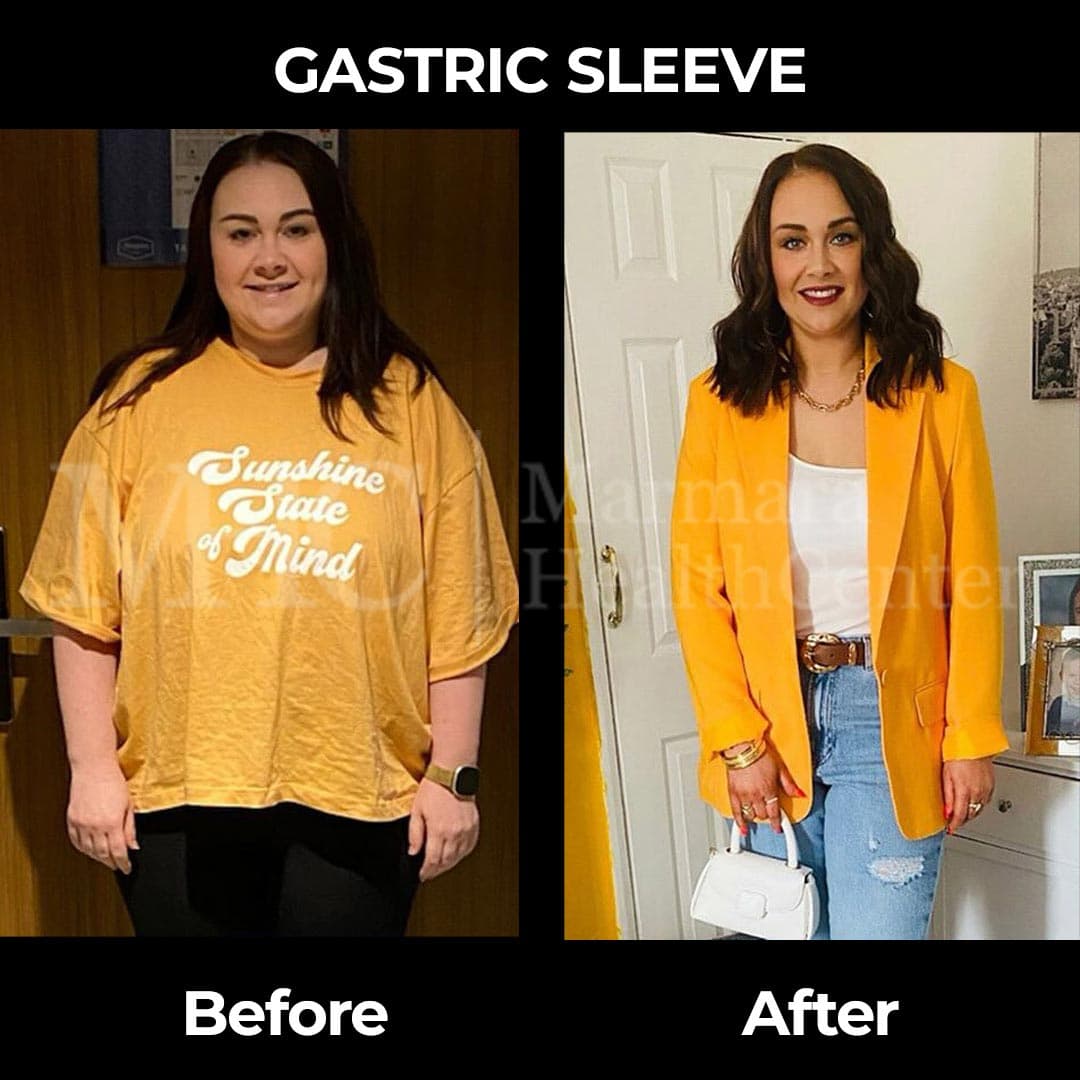 Gastric sleeve before-after — weight loss journey