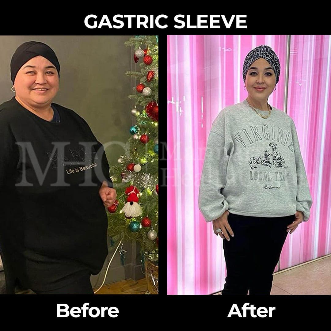 Gastric sleeve before-after result #30 — bariatric surgery outcome