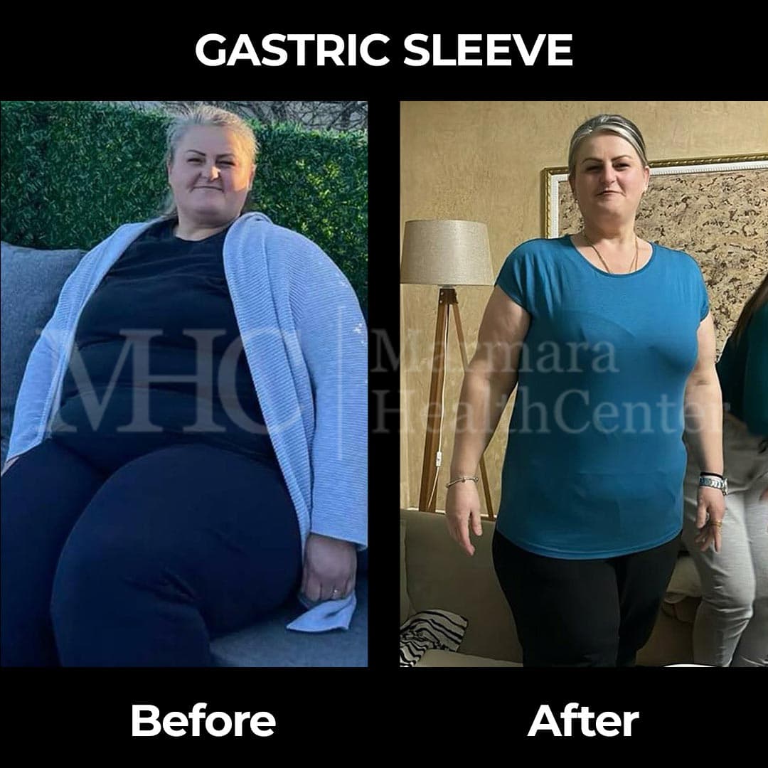 Gastric sleeve before-after result #31 — bariatric surgery outcome