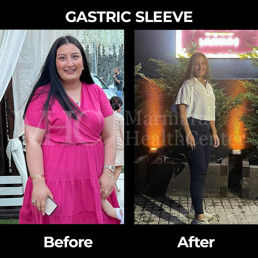Gastric sleeve before-after result #32 — bariatric surgery outcome
