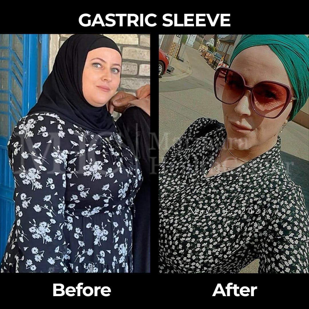 Gastric sleeve before-after result #33 — bariatric surgery outcome