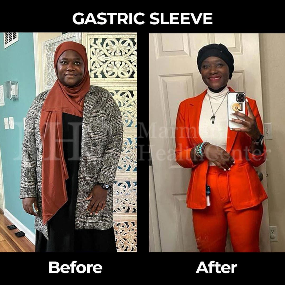 Gastric sleeve before-after result #34 — bariatric surgery outcome