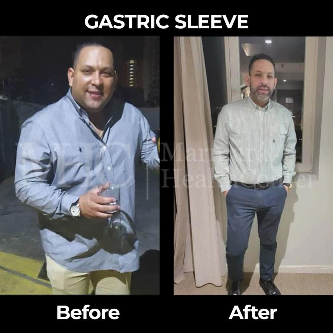 Gastric sleeve before-after result #35 — bariatric surgery outcome