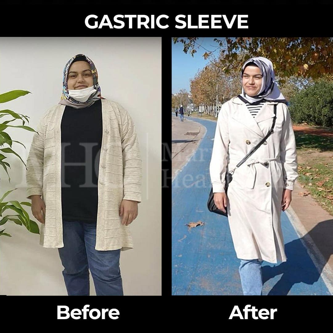 Gastric sleeve before-after result #36 — bariatric surgery outcome