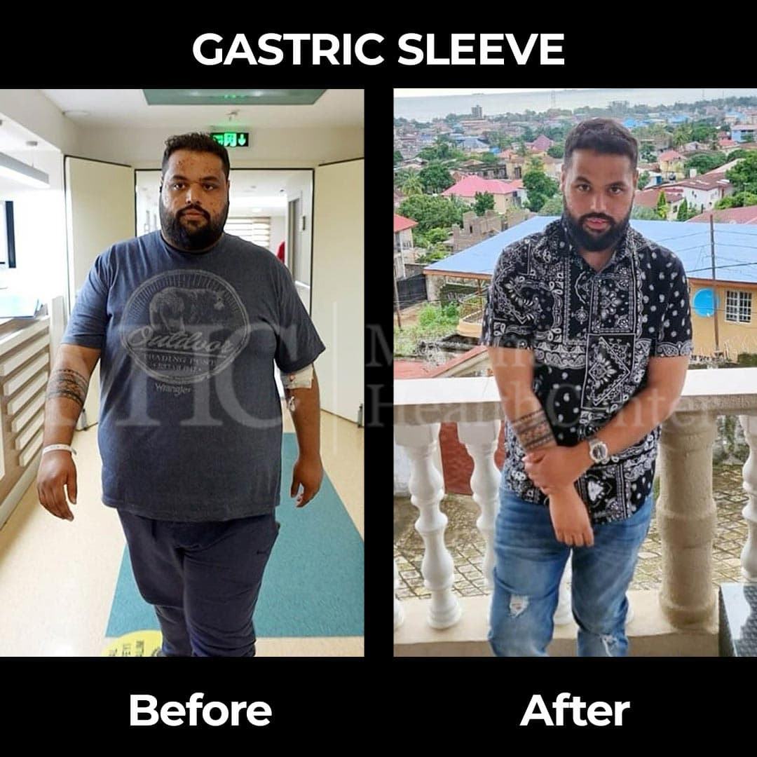 Gastric sleeve before-after result #37 — bariatric surgery outcome