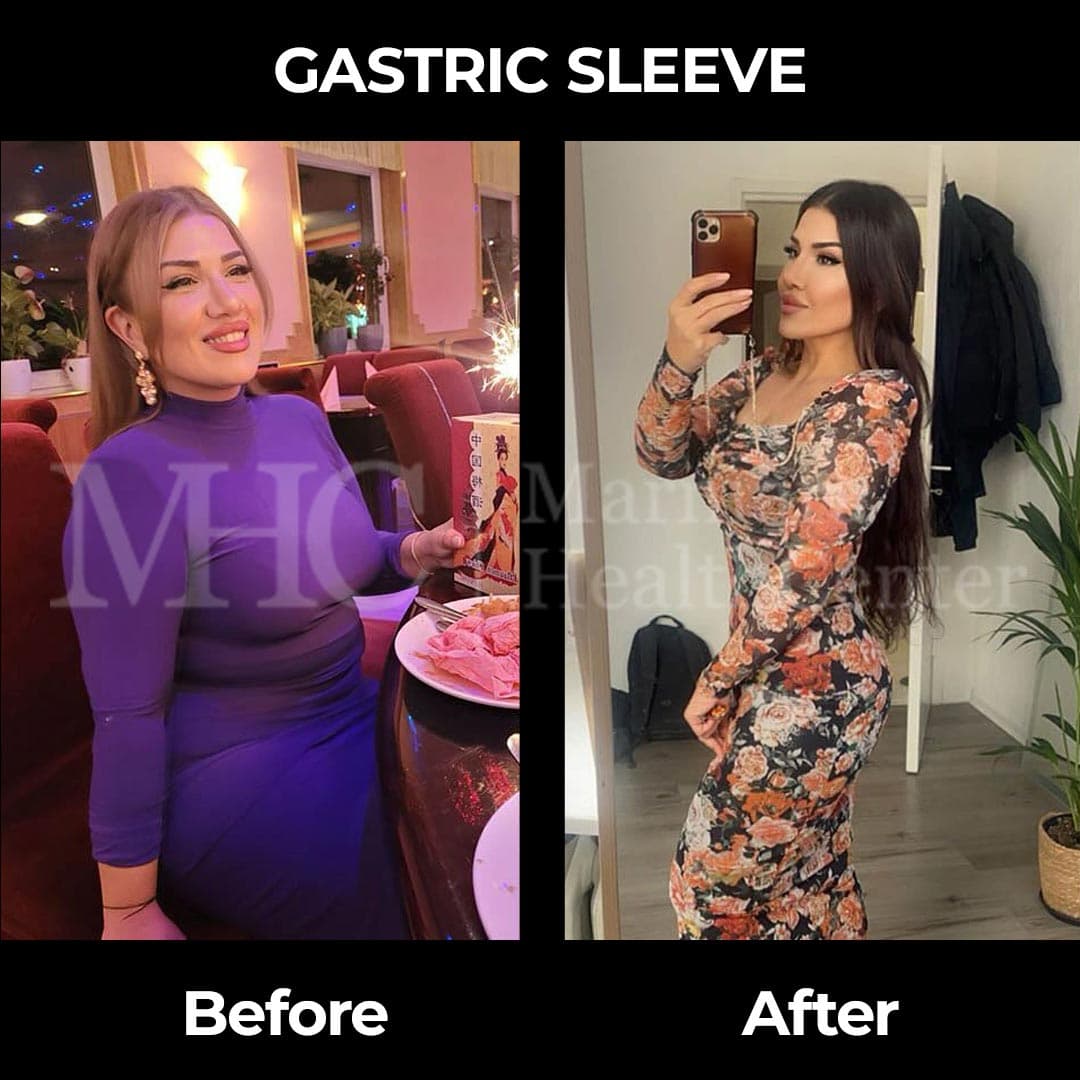 Gastric sleeve before-after result #38 — bariatric surgery outcome