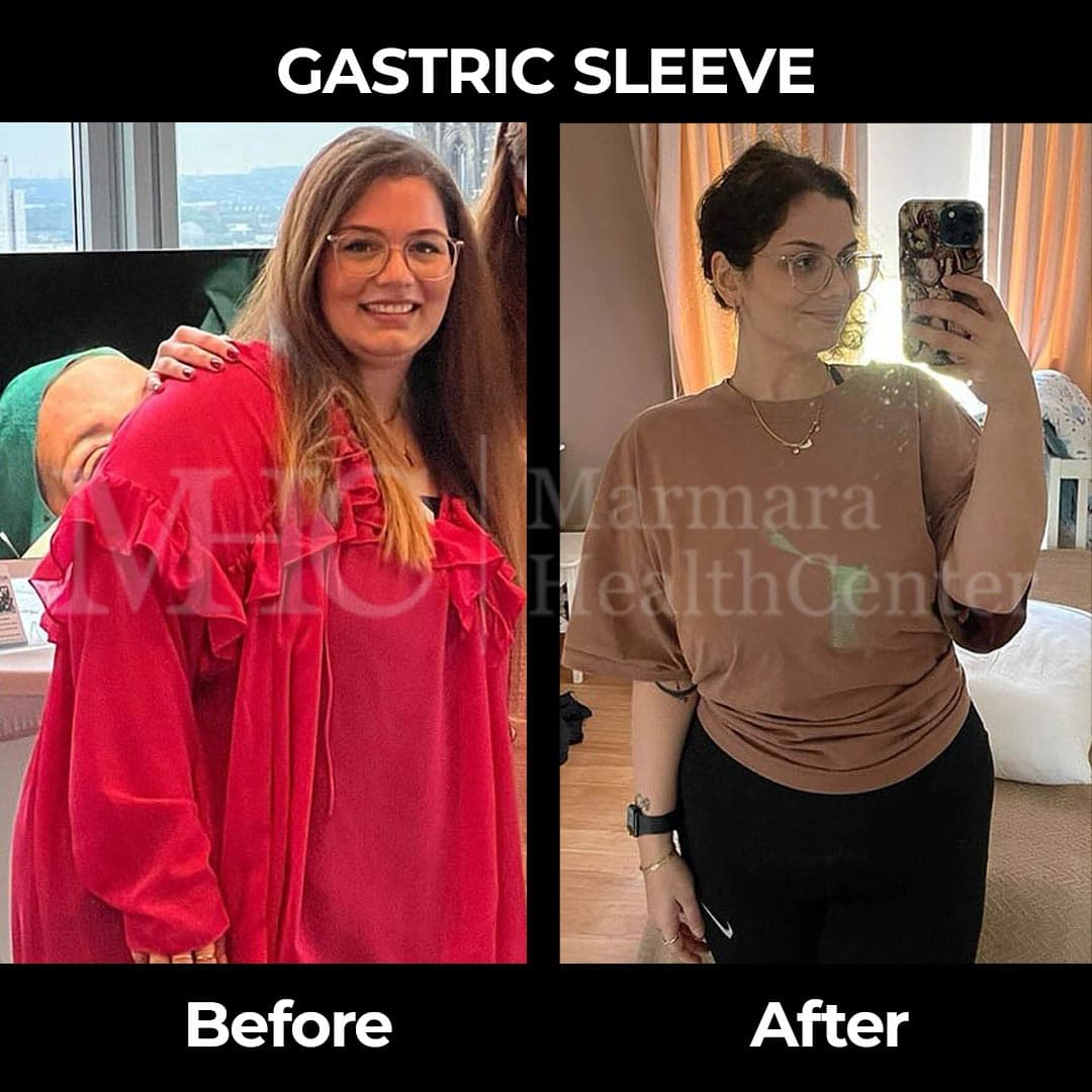 Gastric sleeve before-after result #39 — bariatric surgery outcome