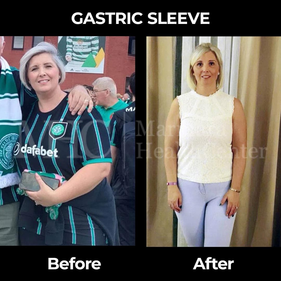 Gastric sleeve before-after result #4 — bariatric surgery outcome