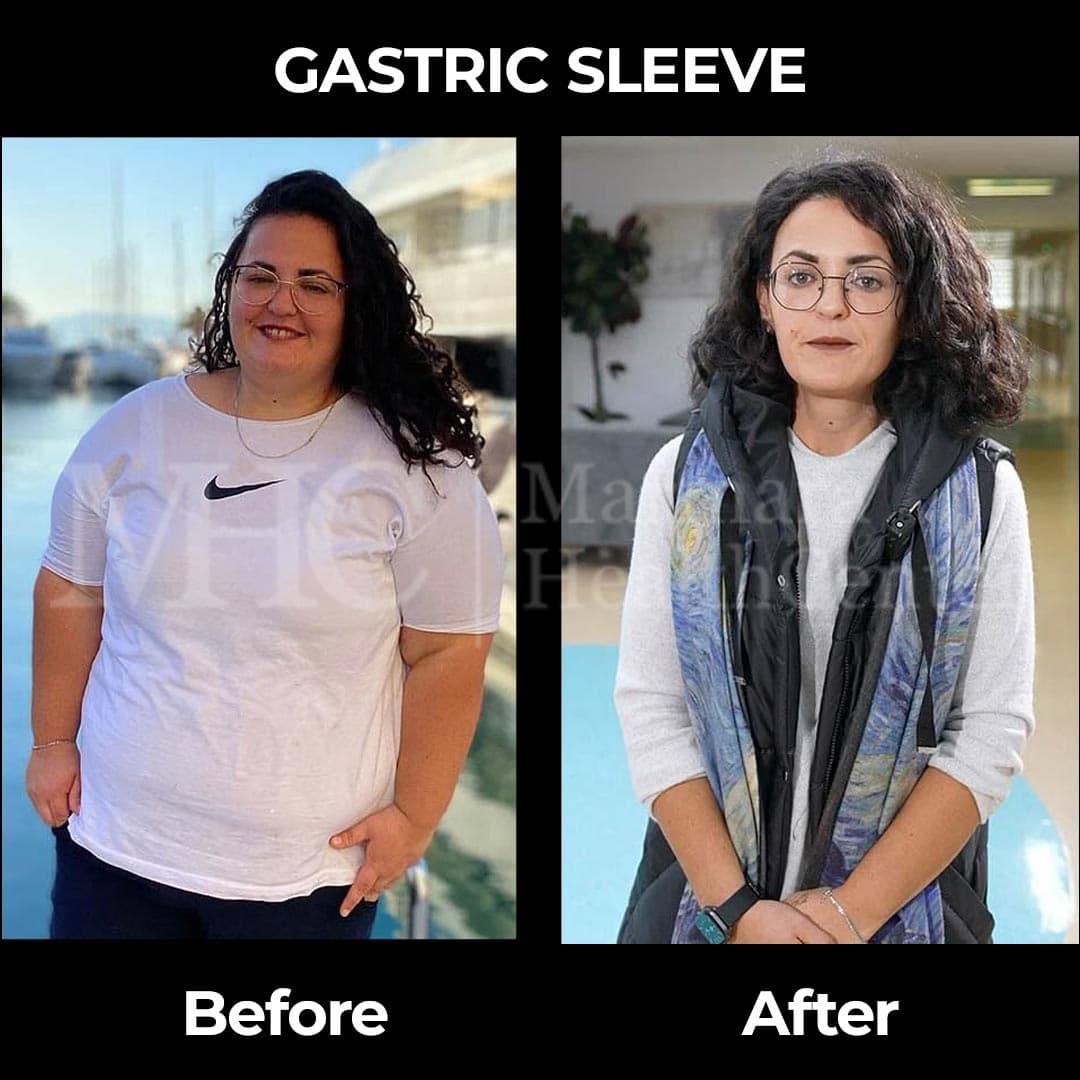 Gastric sleeve before-after result #5 — bariatric surgery outcome