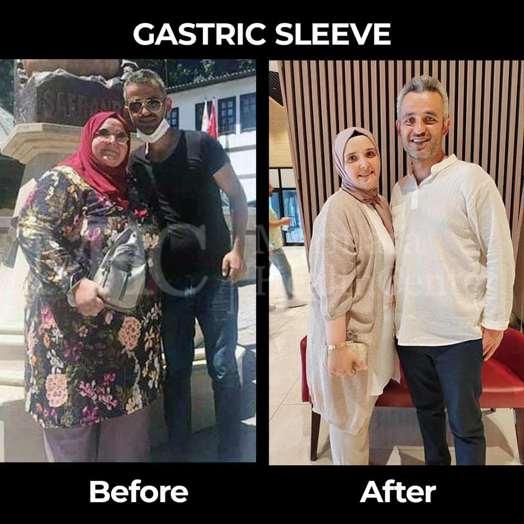 Gastric sleeve before-after result #6 — bariatric surgery outcome