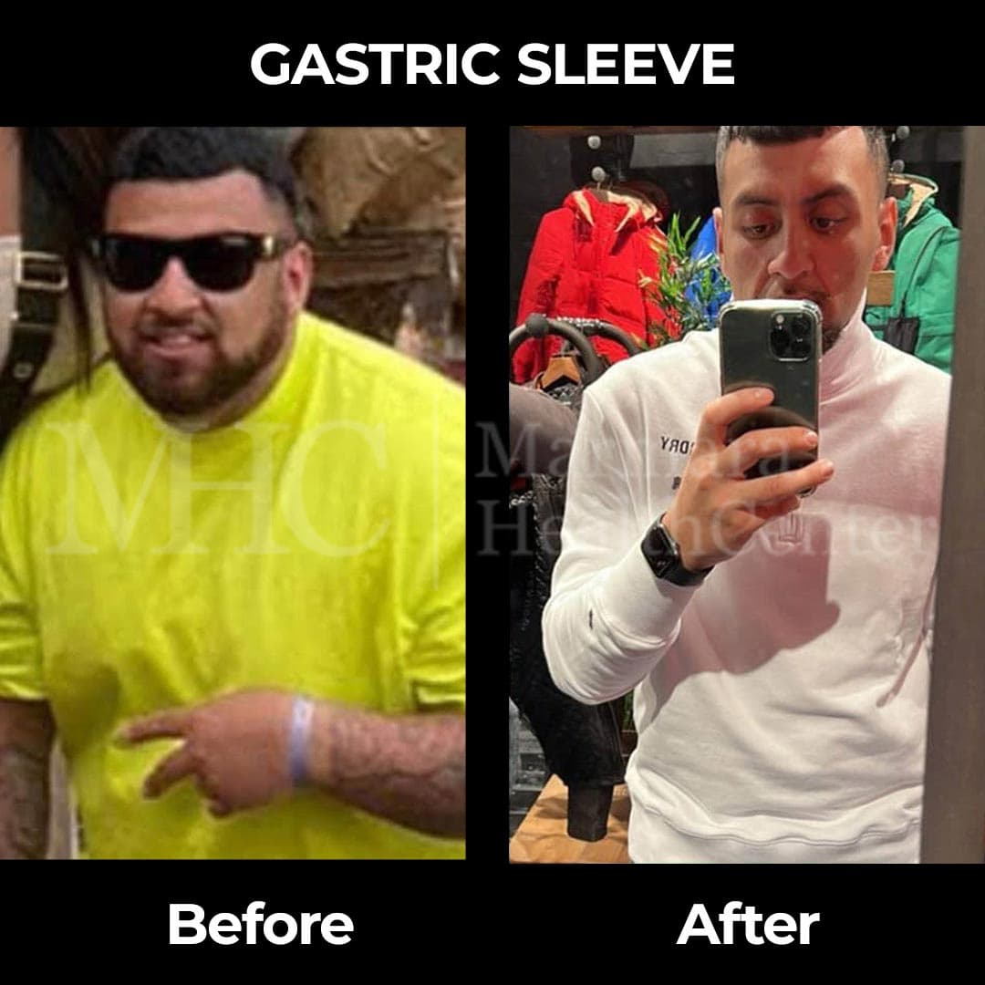 Gastric sleeve before-after result #7 — bariatric surgery outcome