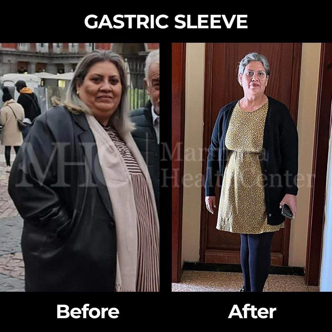 Gastric sleeve before-after result #8 — bariatric surgery outcome