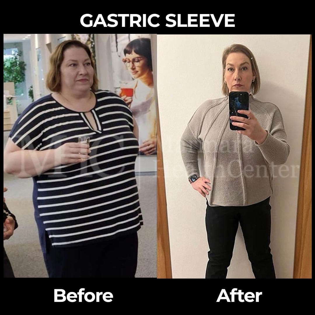 Gastric sleeve before-after result #9 — bariatric surgery outcome