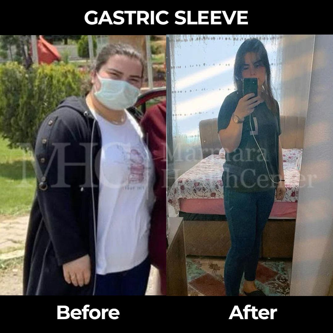 Gastric sleeve before-after — sleeve gastrectomy result