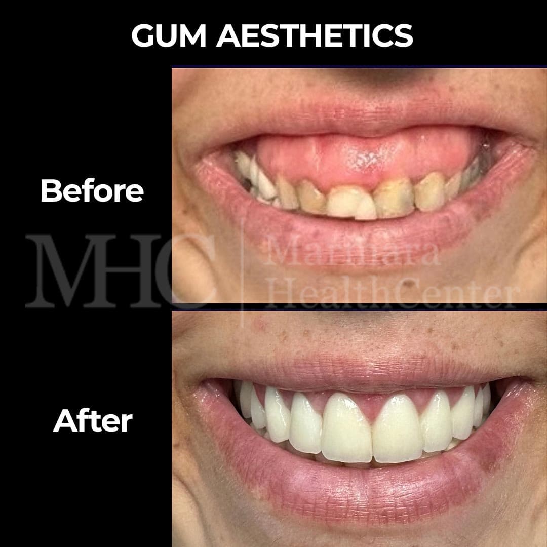 Gum aesthetics before-after — pink aesthetics