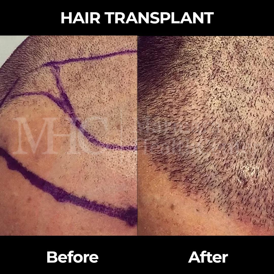 Hair transplantation before-after result — Sapphire FUE