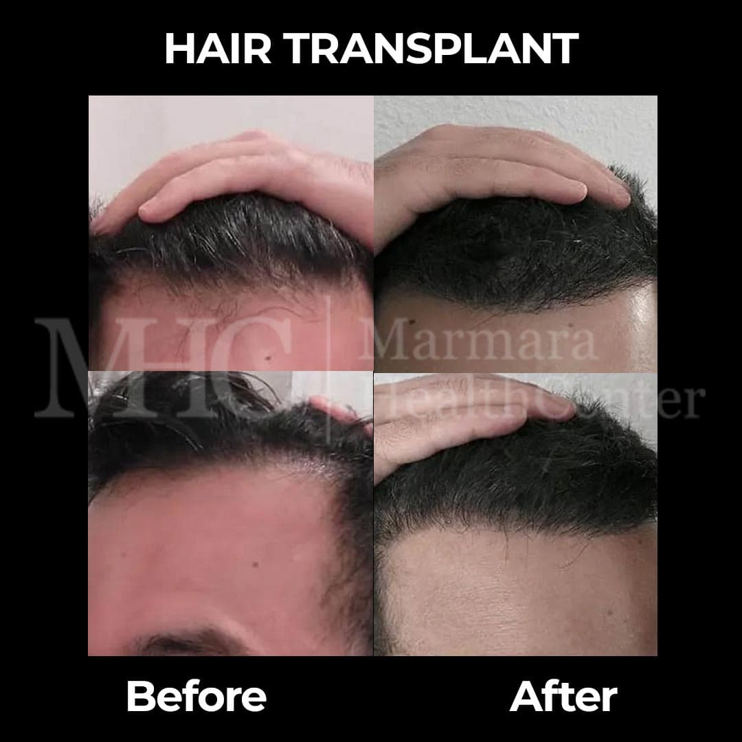 Hair transplant before-after result #4 — Marmara Health Center
