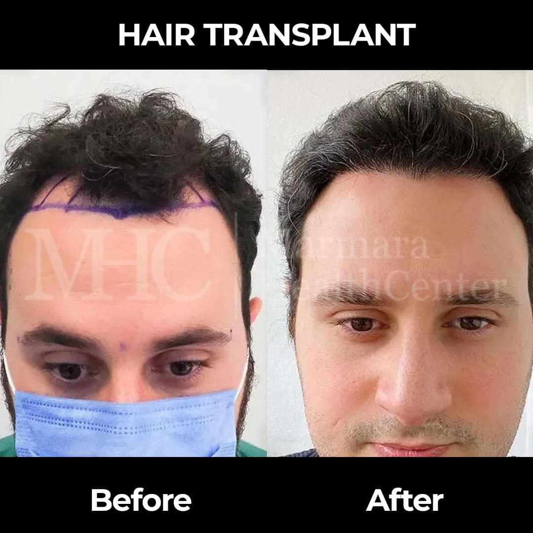 Hair transplant before-after result #5 — Marmara Health Center